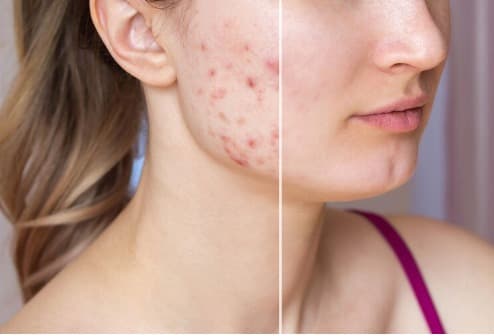 Acne Treatment