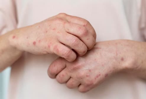 Eczema Treatment
