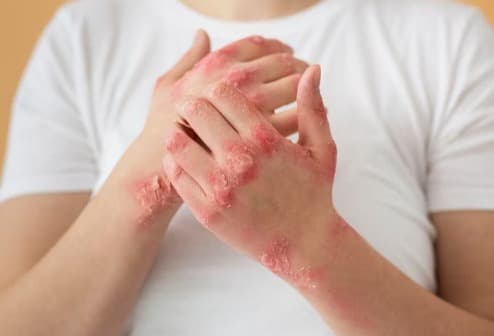 Psoriasis treatment